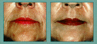 http://www.mixtoskinresurfacing.com/images/noselipsshega1.gif